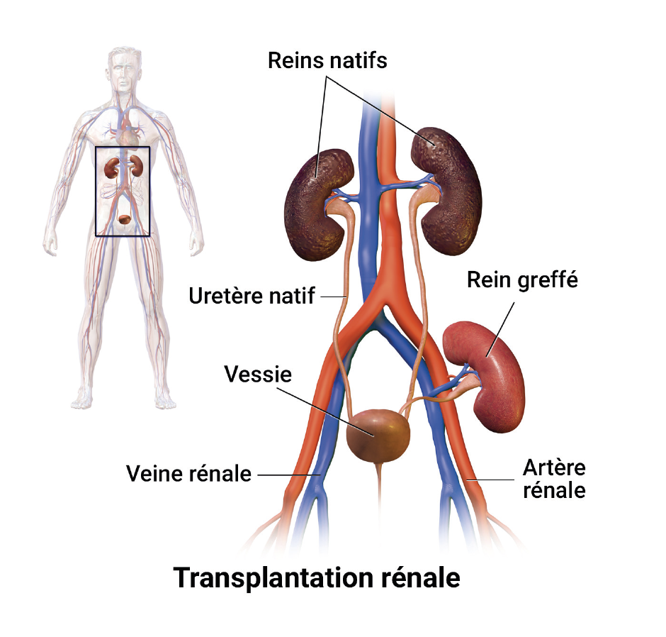 La transplantation rénale Un nouveau départ CHL